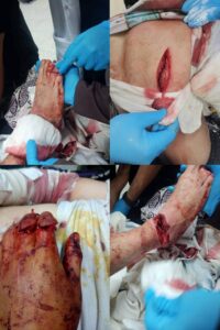 إصابة شاب بطلق ناري في اعتداء بأسلحة نارية بقرية زهرة بالمنيا